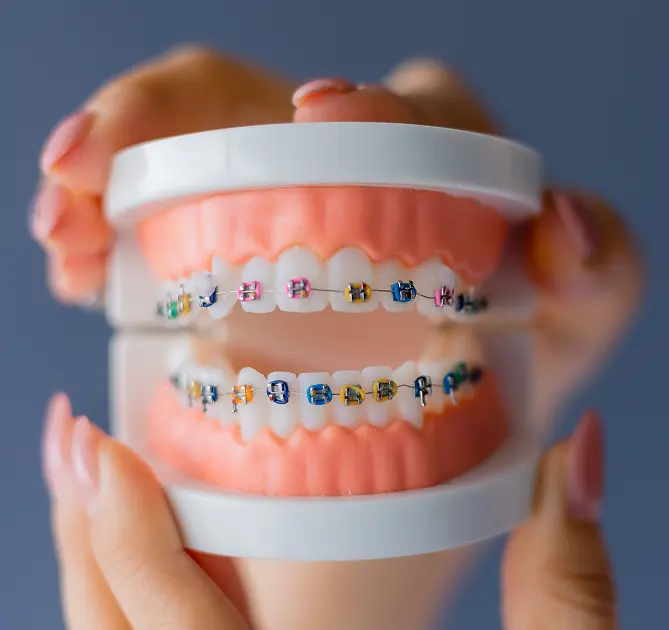 Types of Braces