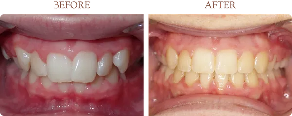 Before and after orthodontic treatment - Case 1