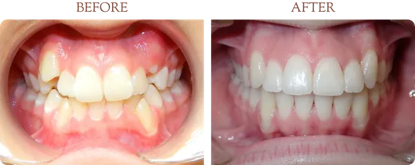 Before and after orthodontic treatment - Case 2