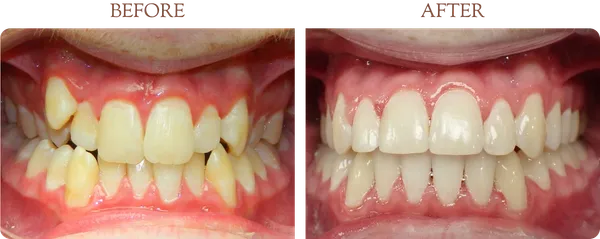 Before and after orthodontic treatment - Case 3