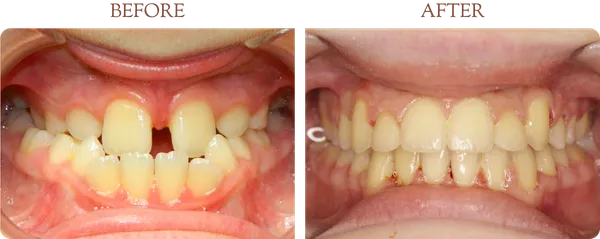Before and after orthodontic treatment - Case 4