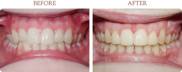 Before and after orthodontic treatment - Case 5
