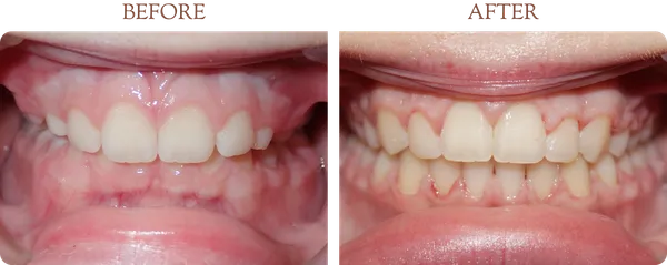 Before and after orthodontic treatment - Case 6