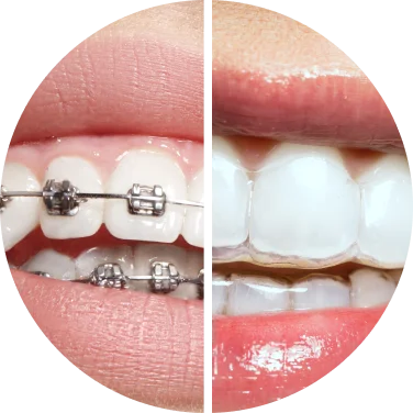 Types of Braces